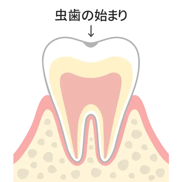 初期の脱灰