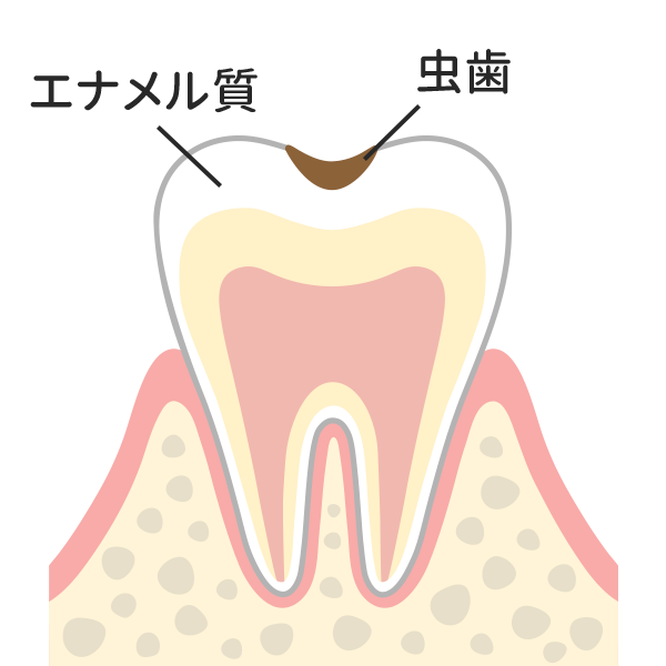 エナメル質の範囲だけの虫歯