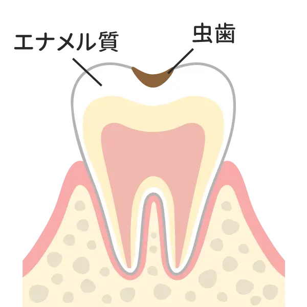 エナメル質の範囲だけの虫歯