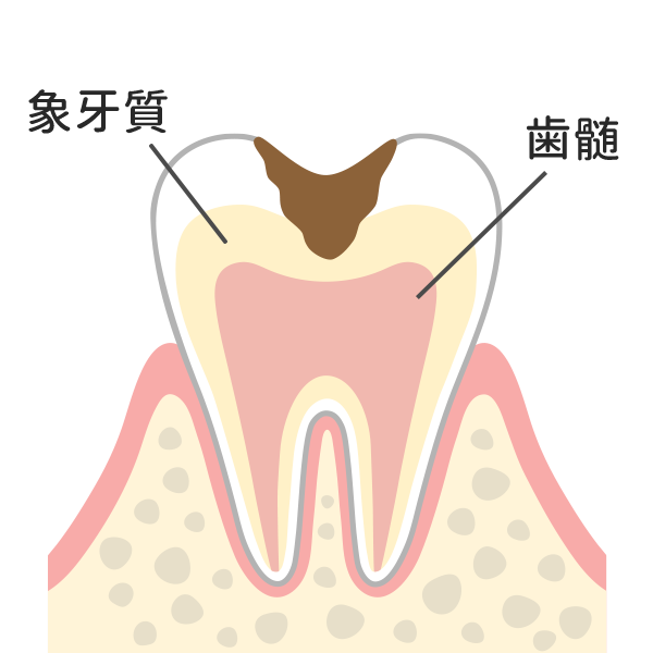 象牙質まで進行した虫歯