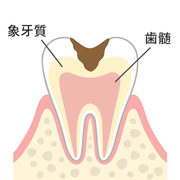 象牙質まで進行した虫歯
