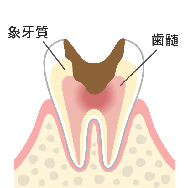 神経まで達した虫歯
