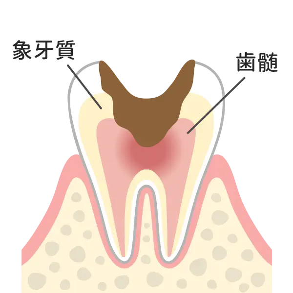 神経まで達した虫歯