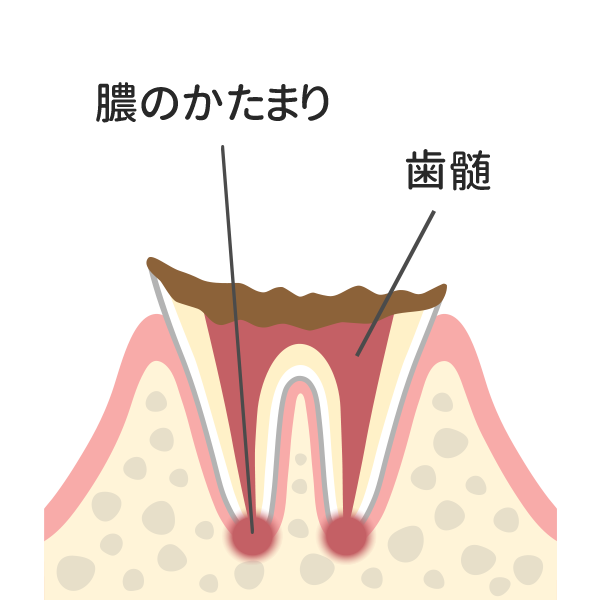 歯の根まで進行した虫歯