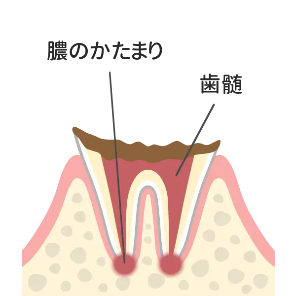 歯の根まで進行した虫歯