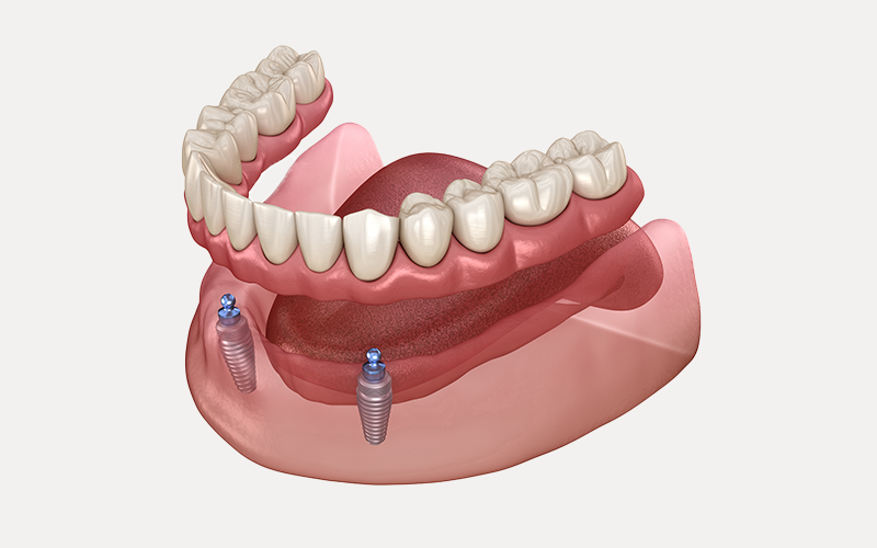 インプラントオーバーデンチャー