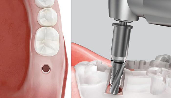 痛みや腫れに配慮