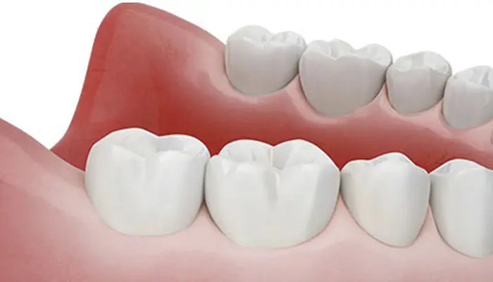 手術当日の仮歯装着に対応できる場合も