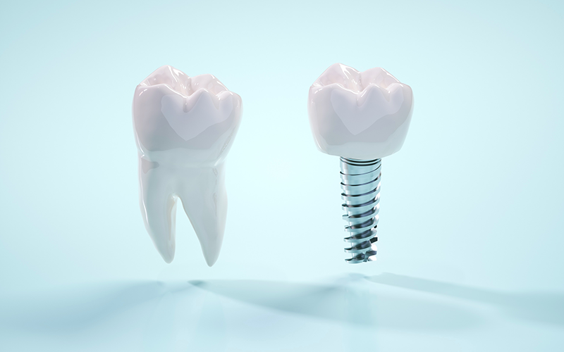 インプラント治療について