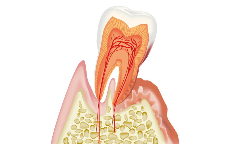歯周病について