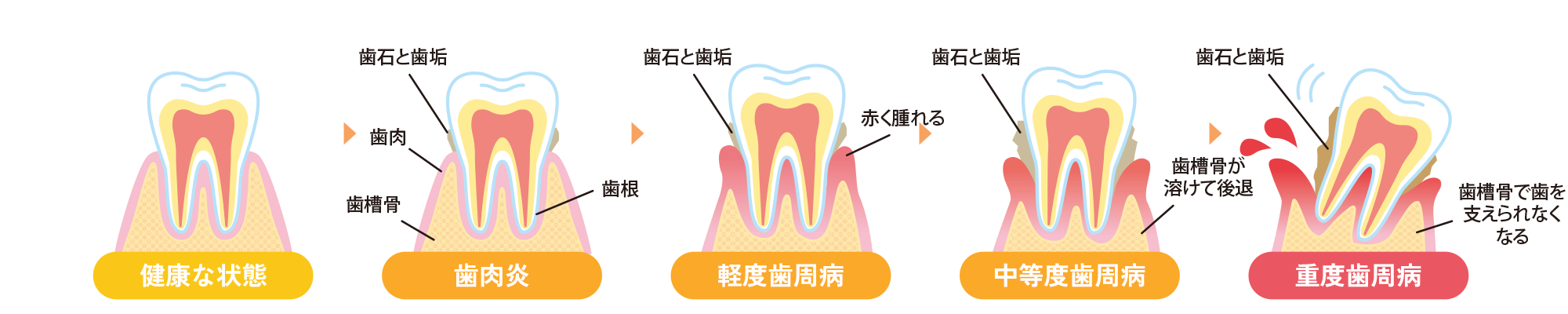 歯周病の進行